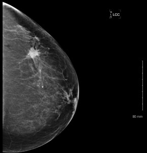 mammogram