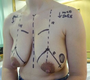 This is someone else's boobs getting marked up for Oncoplastic Reduction
