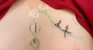 Newly Discovered Klee Painting on my Boob